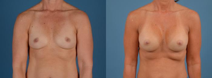 Before & After Breast Augmentation Case 14 Front View in Frisco, TX