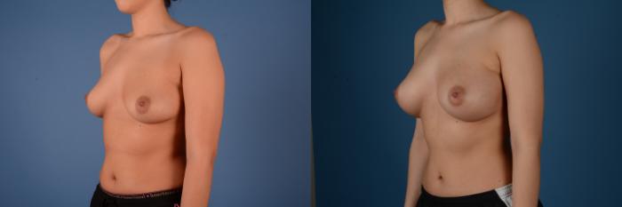 Before & After Breast Augmentation Case 20 Left Oblique View in Frisco, TX
