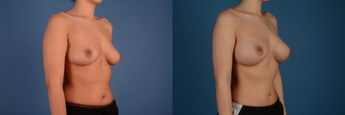 Before & After Breast Augmentation Case 20 Right Oblique View in Frisco, TX