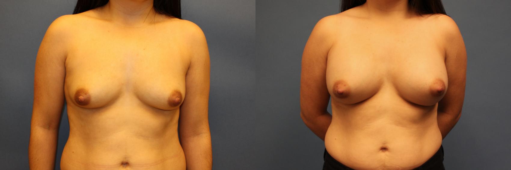 Before & After Breast Augmentation Case 21 Front View in Frisco, TX