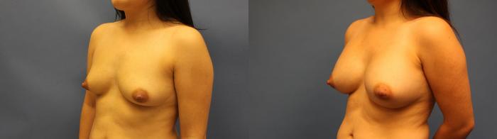 Before & After Breast Augmentation Case 21 Left Oblique View in Frisco, TX
