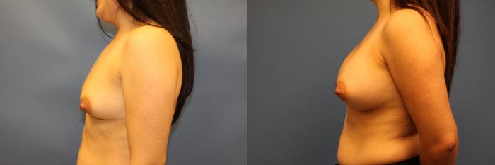 Before & After Breast Augmentation Case 21 Left Side View in Frisco, TX