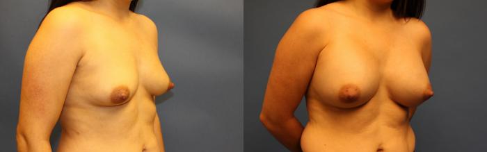 Before & After Breast Augmentation Case 21 Right Oblique View in Frisco, TX