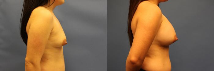 Before & After Breast Augmentation Case 21 Right Side View in Frisco, TX