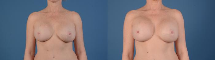 Before & After Breast Augmentation Case 22 Front View in Frisco, TX