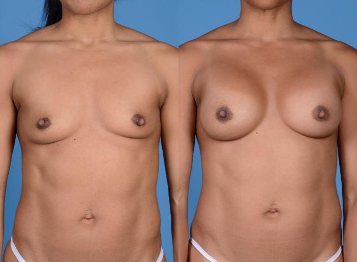 Before & After Breast Augmentation Case 7 Front View in Frisco, TX