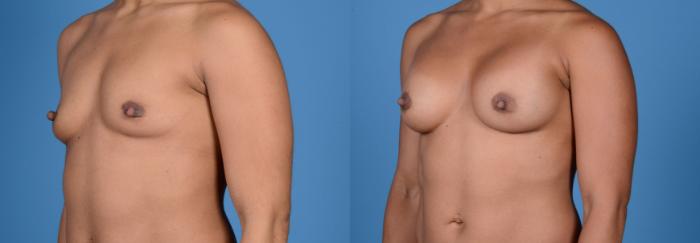 Before & After Breast Augmentation Case 7 Left Oblique View in Frisco, TX