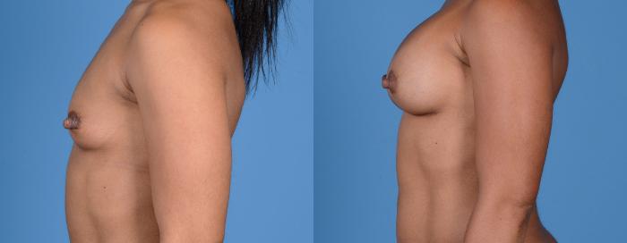 Before & After Breast Augmentation Case 7 Left Profile View in Frisco, TX