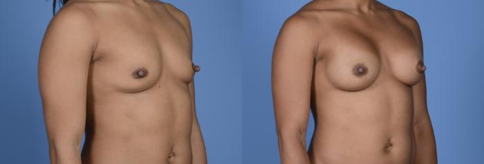 Before & After Breast Augmentation Case 7 Right Oblique View in Frisco, TX