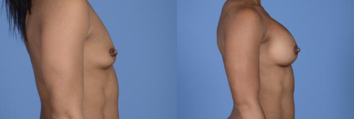 Before & After Breast Augmentation Case 7 Right Profile View in Frisco, TX