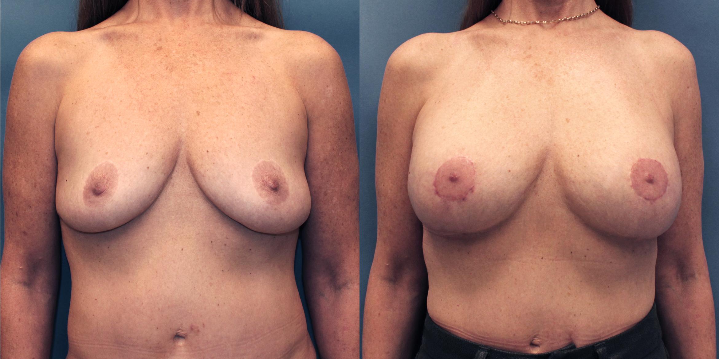 Before & After Breast Lift (Mastopexy) Case 19 View #1 View in Frisco, TX