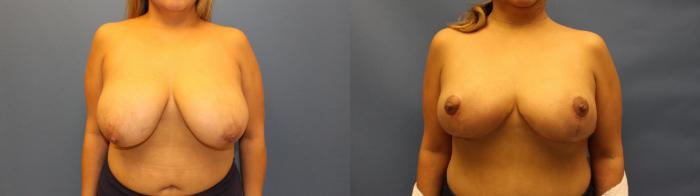 Before & After Breast Lift (Mastopexy) Case 26 Front View in Frisco, TX