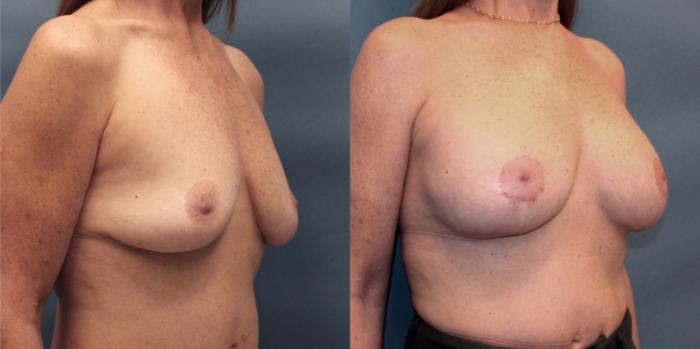 Before & After Breast Lift with Implants Case 19 View #2 View in Frisco, TX