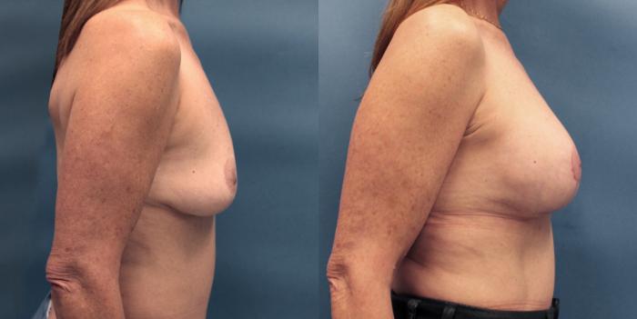 Before & After Breast Lift with Implants Case 19 View #3 View in Frisco, TX