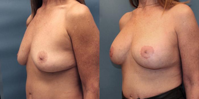 Before & After Breast Lift with Implants Case 19 View #4 View in Frisco, TX