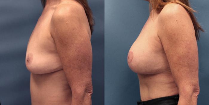 Before & After Breast Lift with Implants Case 19 View #5 View in Frisco, TX