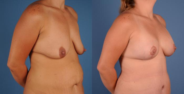 Before & After Breast Lift (Mastopexy) Case 24 Left Oblique View in Frisco, TX