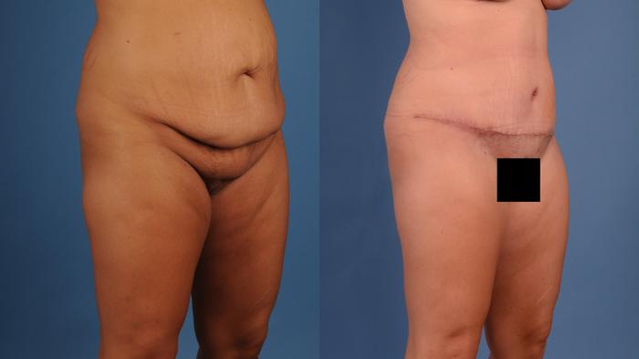 Before & After Tummy Tuck (Abdominoplasty) Case 24 Left Oblique View of Body View in Frisco, TX