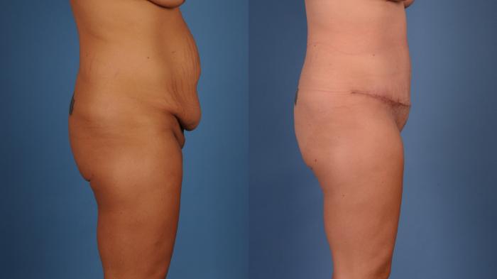 Before & After Mommy Makeover Case 24 Left Profile View of Body View in Frisco, TX