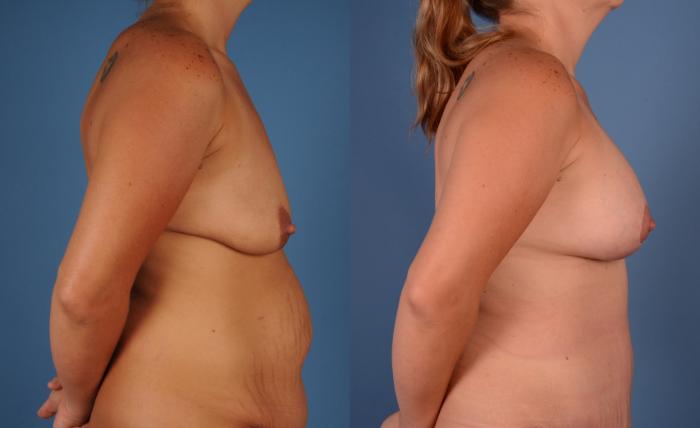 Before & After Tummy Tuck (Abdominoplasty) Case 24 Left Side View in Frisco, TX