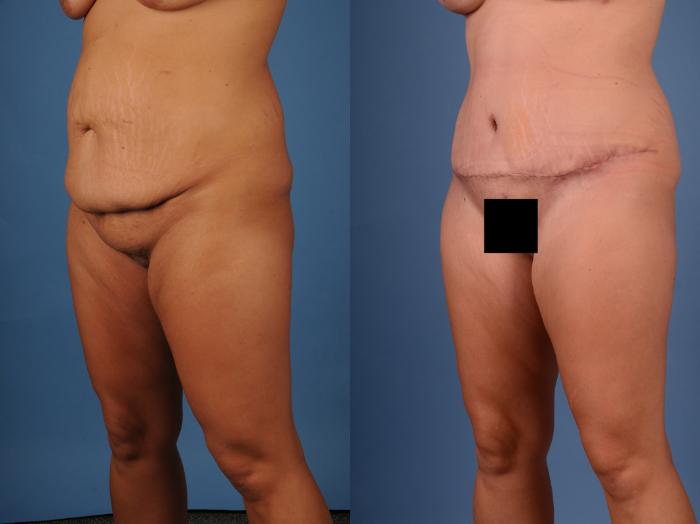 Before & After Mommy Makeover Case 24 Right Oblique View of Body View in Frisco, TX