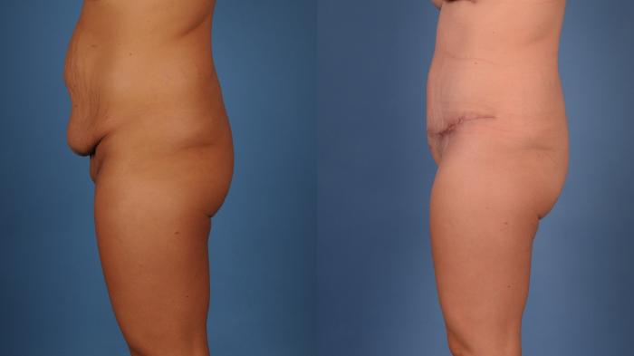 Before & After Tummy Tuck (Abdominoplasty) Case 24 Right Profile View of Body View in Frisco, TX