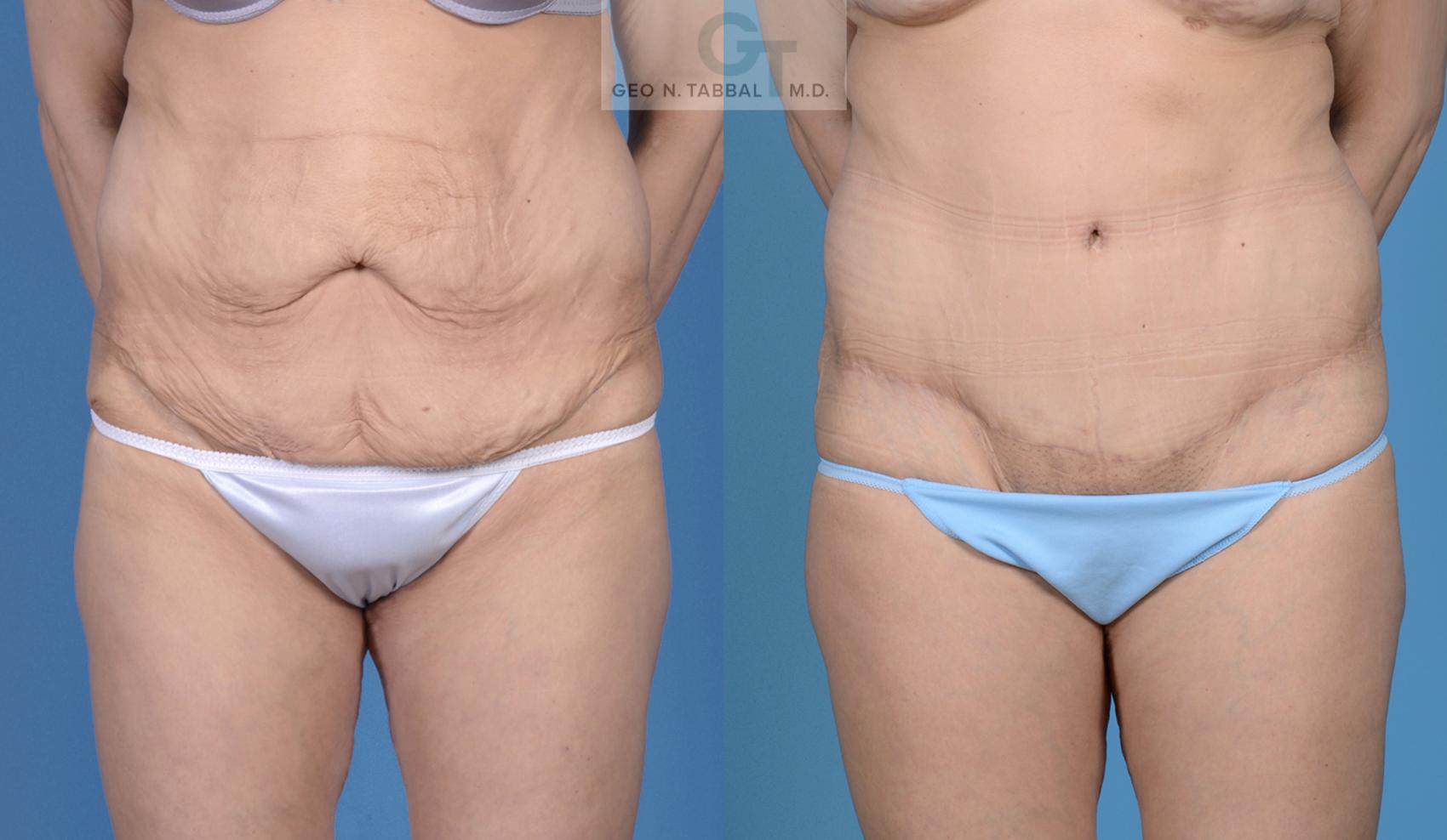 Before & After Tummy Tuck (Abdominoplasty) Case 18 View #1 View in Frisco, TX