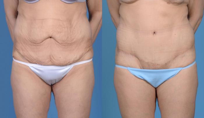 Before & After Tummy Tuck (Abdominoplasty) Case 18 View #1 View in Frisco, TX