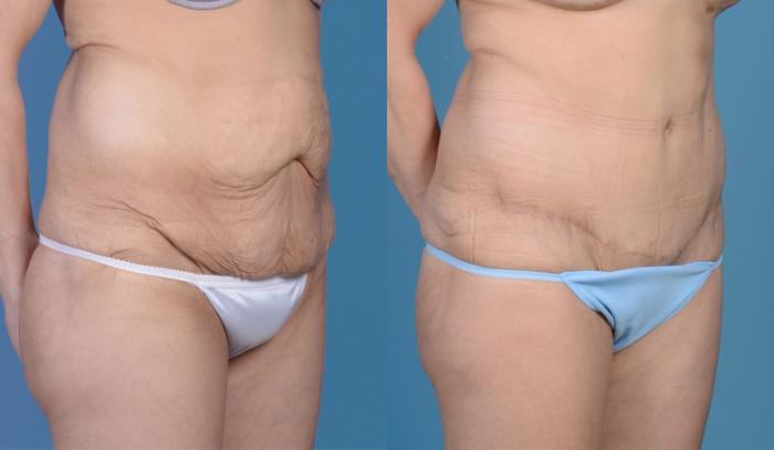 Before & After Tummy Tuck (Abdominoplasty) Case 18 View #2 View in Frisco, TX