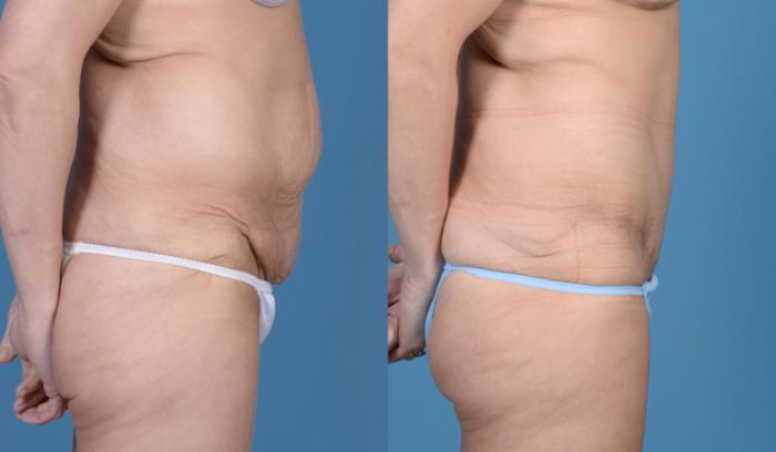 Before & After Tummy Tuck (Abdominoplasty) Case 18 View #3 View in Frisco, TX