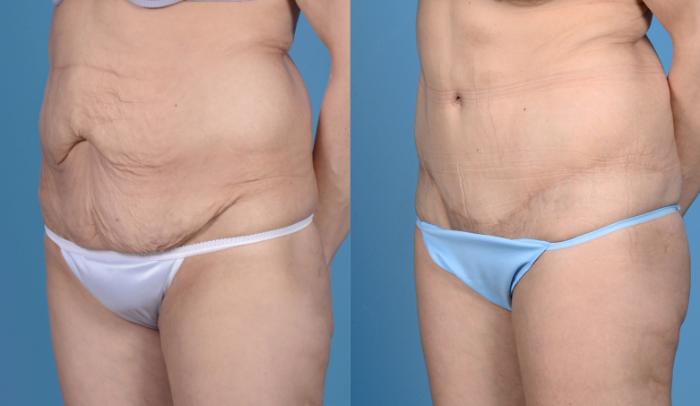 Before & After Tummy Tuck (Abdominoplasty) Case 18 View #4 View in Frisco, TX