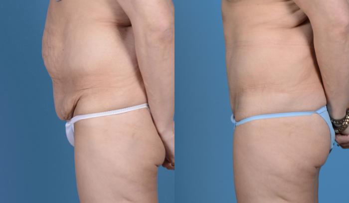 Before & After Tummy Tuck (Abdominoplasty) Case 18 View #5 View in Frisco, TX